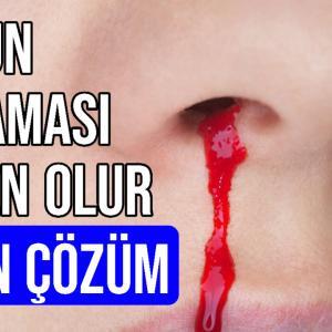 Burun Kanaması Neden Olur Nasıl Durdurulur
