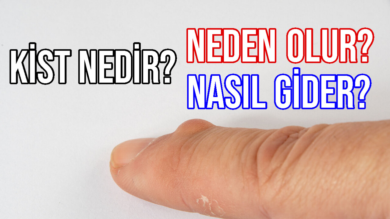 kist nedir neden olur nasıl gider